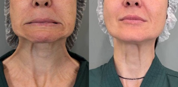 Платизма: невидимый союзник деформации лица и их влияние на эстетические процедуры